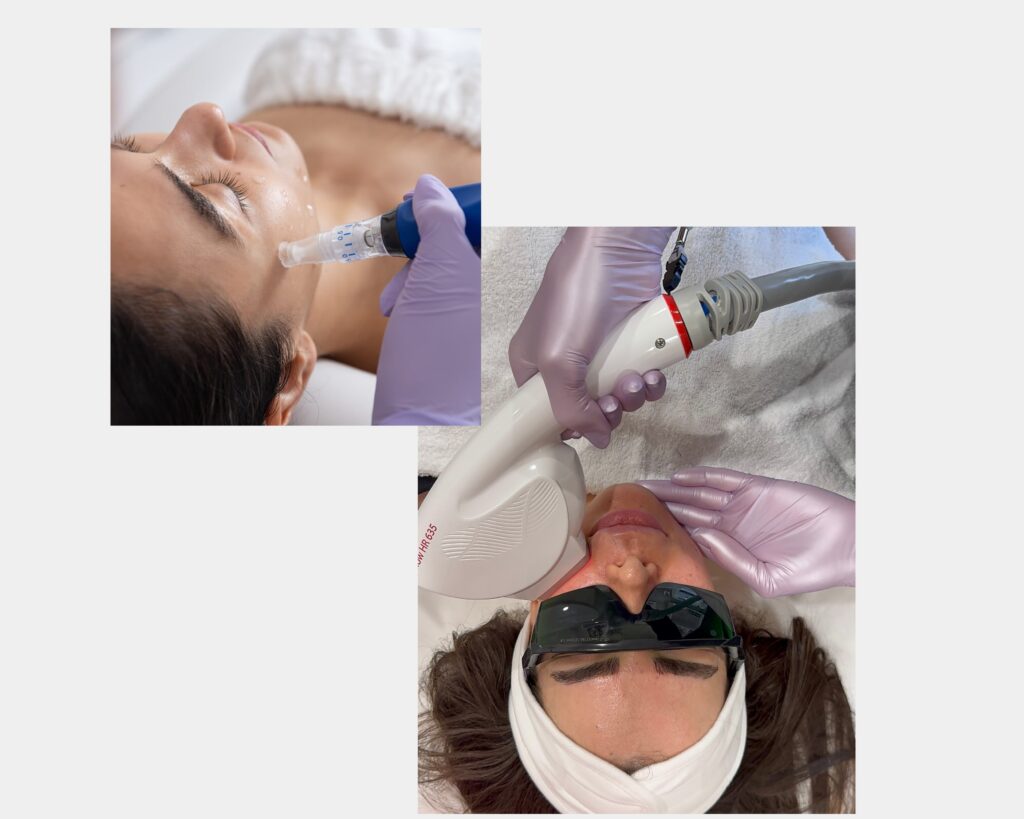 Laser hair removal treatment on woman's face at William Tissert Salon